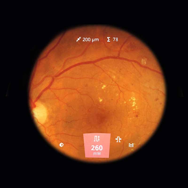 ZEISS VISULAS Green. Unmatched workflow efficiency in laser therapy.